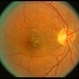 Leber's Stellate Maculopathy